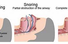cpap tongue base reduction works sleep airway apnea obstruction osa diagram obstructive