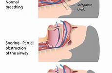 apnea osa obstructive snoring