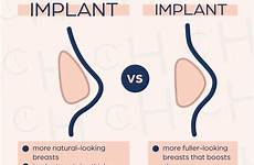implants teardrop augmentation bust inspo confidence