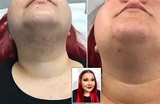 pcos hair facial woman growing 20s who her