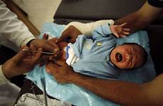 circumcision baby pain infant facts