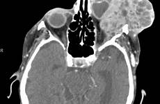 gland lacrimal cystic ct adenoid carcinoma maxillofacial imaging coronal orbital performed repeat bone cases contrast left sagittal mass