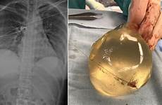 woman breast implant bullet implants her chest gunshot cnn after shot silicone old when wound deflects saving life womans top