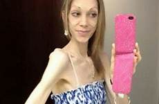 anorexic anorexia transformation nicola thinnest swns fought anoréxica culturista culturismo campeona morir brink