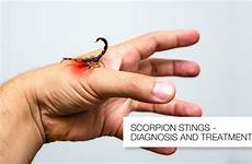 scorpion stings treatment diagnosis apollo scorpions balakrishna