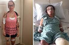 amputee meningitis limbs mannequin mirror lost woman who