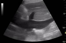 ultrasound pericardial tamponade effusion differentiating ivc valve inferior cava vena plump collapsible