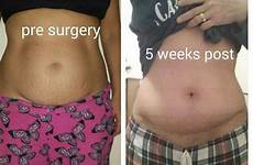 tummy tuck after before lipo abdominoplasty prices