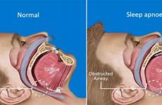 snoring sleep apnoea oral appliance therapy causes stop throat anatomical tongue diagnosis