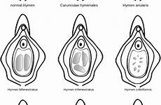 hymen tissue visual introitus configurations myths dispelling couldn assault determining