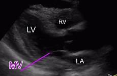 pericardial tamponade ultrasound effusion aliem differentiating tricuspid waqas ayesha