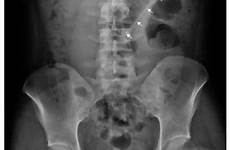 rectum retained radiograph contour inserted