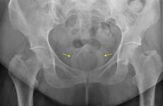 prolapse uterine ultrasound pessary radiology hospital orientalis vespa