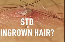 ingrown hair std pimples male manscaped between man guys difference there