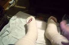 broken feet