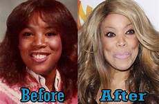 wendy williams before surgery plastic nose job after man look young breast skin implants she african alike women american facial