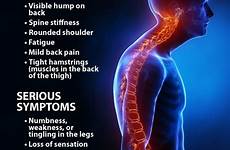 kyphosis cyphose posture spine brace hunch curve