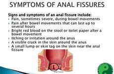 fissure fissures anus visible stool