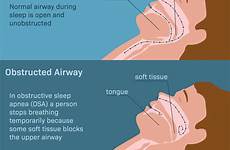 apnea obstructive disorders airway tissue occurs