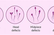 sperm defects morphological abnormal malformations deformations spermatozoides invitra exist