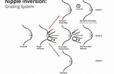 nipple inverted correction breastfeeding grading inversion surgery