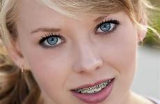 braces teenagers blond eyed haired oralanswers