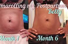postpartum skin belly stretch dermarolling saggy