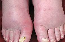 edema feet swelling