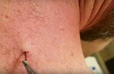 ingrown hair removal removed allure being