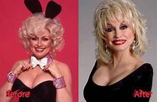 parton dolly surgery plastic before after old getting mistakes facelift gracefully