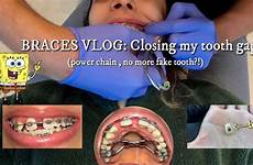 braces expander tooth palatal