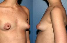 tits puffy malformed areolas