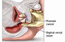 prostate cancer health spot massage male depth finger therapy men prostata exam rectum into sex reach advanced report effects