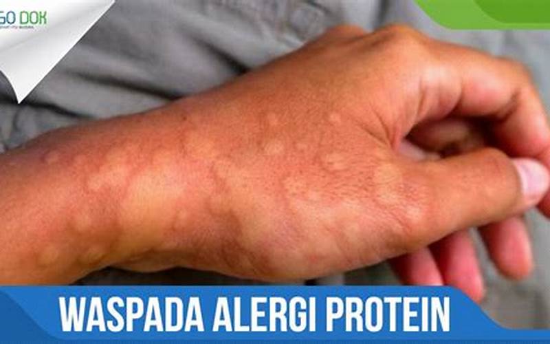Alergi Protein Menyebabkan Jerawat