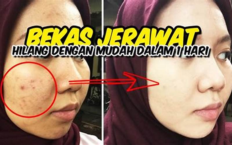 Bagaimana Salepmenghilangkan Jerawat?