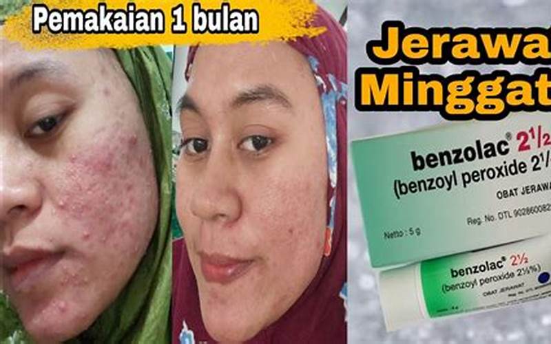 Benzolac Cl Untuk Jerawat: Apa Yang Harus Anda Ketahui?