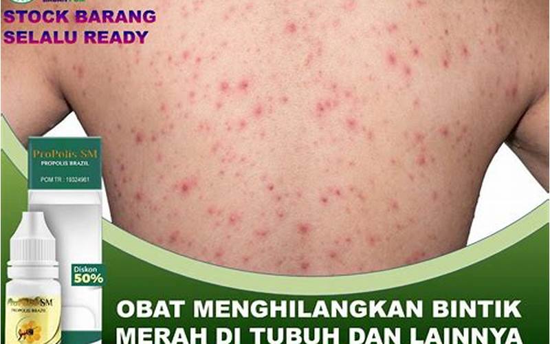 Bintik Merah Seperti Jerawat Di Badan