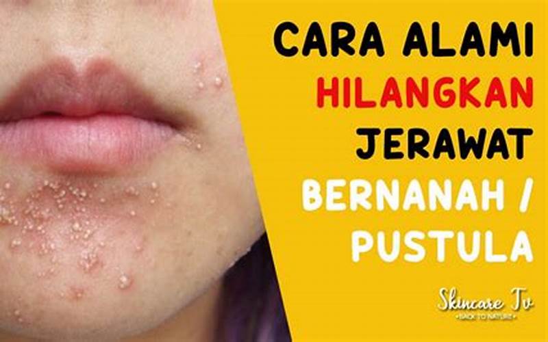 Cara Atasi Jerawat Bernanah