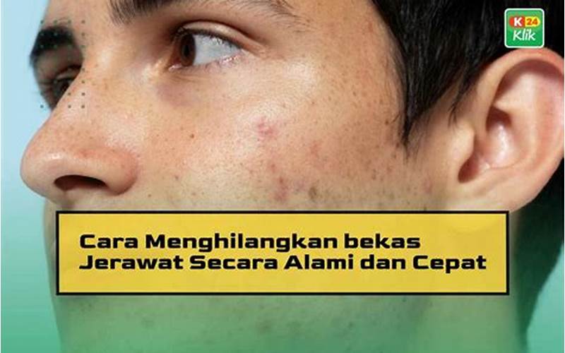 Cara Cepat Hilangkan Bekas Jerawat Merah