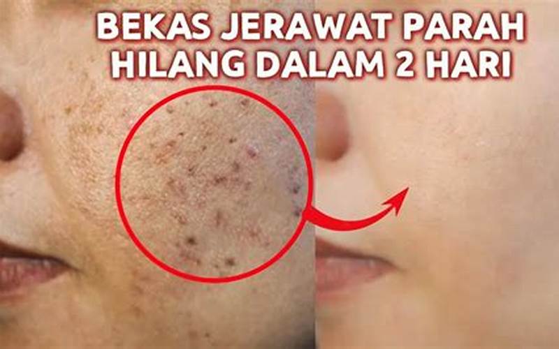 Cara Cepat Menghilangkan Bekas Jerawat Hitam