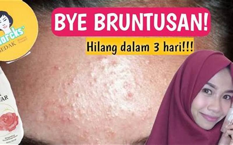 Cara Membedakan Jerawat Dan Bruntusan