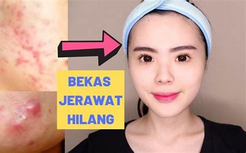 Cara Membuat Jerawat Kempes Secara Alami