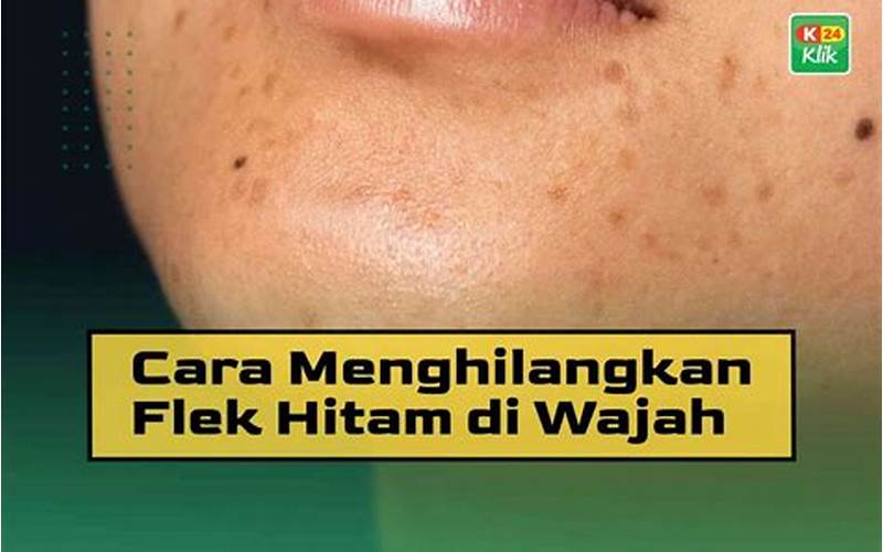 Cara Mengatasi Flek Hitam Jerawat Dengan Mudah