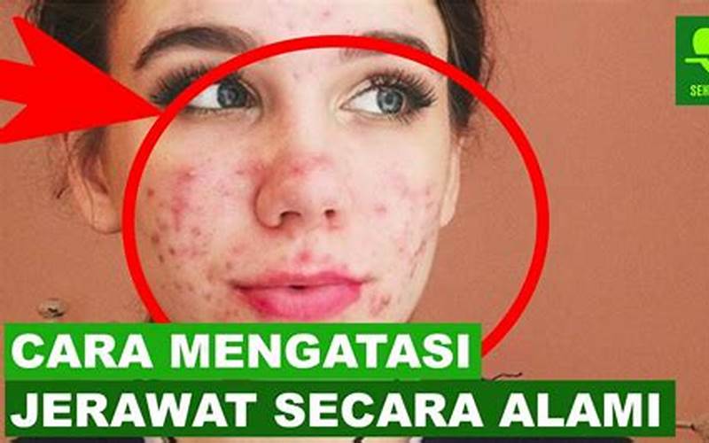 Cara Mengatasi Jerawat Cystic Secara Alami