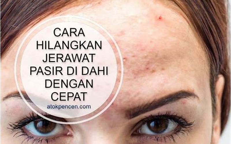 Cara Mengatasi Jerawat Dengan Mudah Dan Cepat