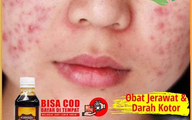 Cara Mengatasi Jerawat Dengan Obat Pembersih Darah Kotor