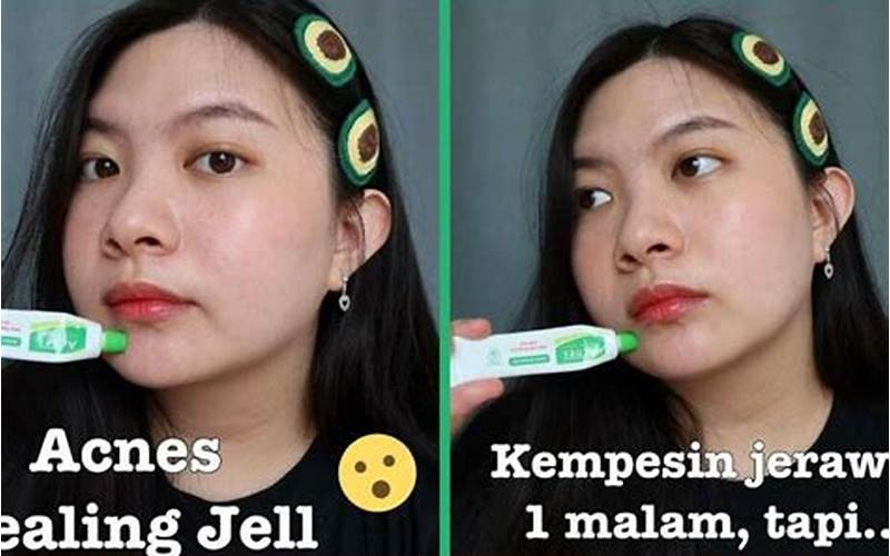 Cara Mengatasi Jerawat Dengan Salep Garamycin