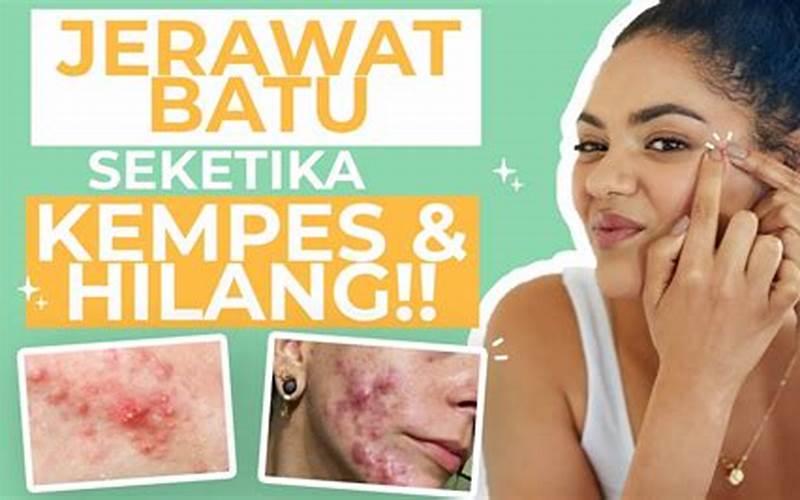 Cara Menghilangkan Jerawat Batu Dengan Obat Alami