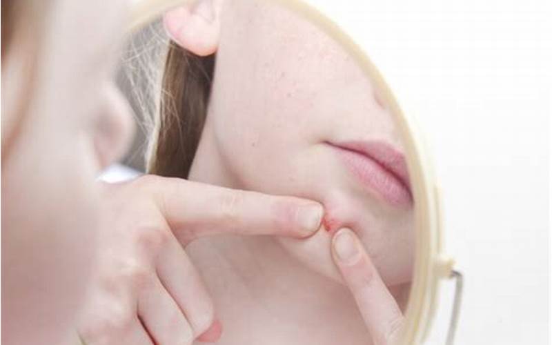 Cara Menghilangkan Jerawat Blind Pimple Di Apotik