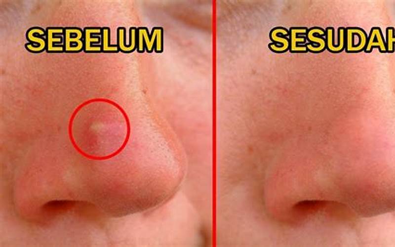 Cara Menghilangkan Jerawat Dekat Lubang Hidung